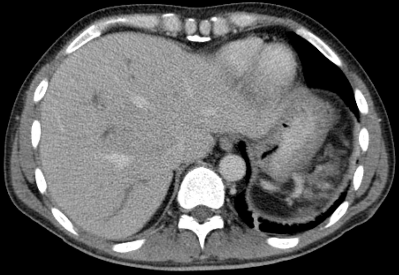 File:Pfortaderthrombose002.png