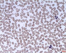 Rouleaux in myeloma patient.jpg