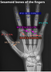 Sesamoid bones of the fingers.svg