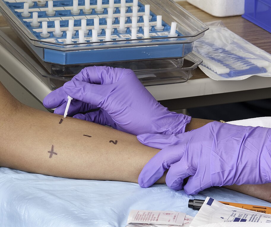 Patch test - Wikipedia