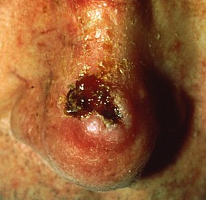 Squamous-cell carcinoma: Commonly presents as a red, crusted, or scaly patch or bump.