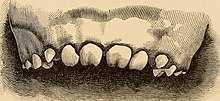Зубы Гетчинсона: диагностика, лечение и профилактика