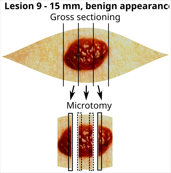 File:Tissue selection from skin excision with lesion 9-15 mm with benign appearance.svg