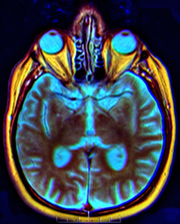 Brain MRI 150443 rgbca t1 t2 t2STIR misreg.png