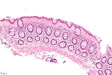 Micrograph of collagenous colitis. H&E stain. Collagenous colitis - intermed mag.jpg