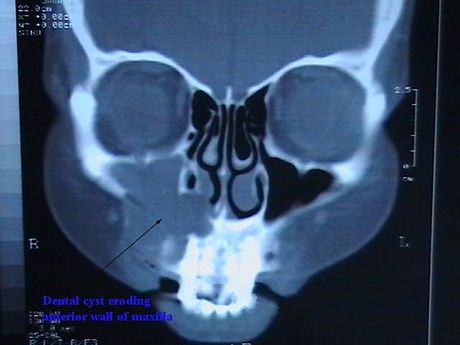 Periapical cyst