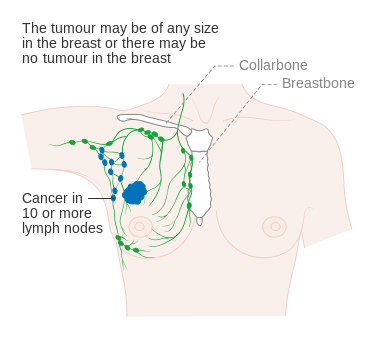 File:Diagram 1 of 3 showing stage 3C breast cancer CRUK 399.svg