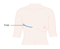 Diagram showing a mastectomy scar CRUK 447.svg