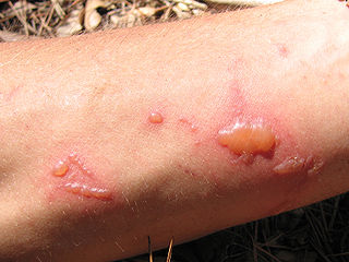 <span class="mw-page-title-main">Phototoxicity</span> Chemically-induced skin irritation following exposure to light