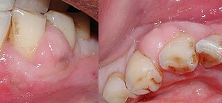 <span class="mw-page-title-main">Periodontal abscess</span> Collection of pus within tissues surrounding a tooth