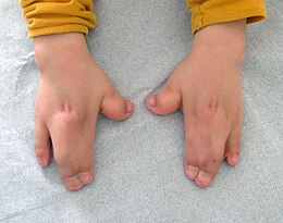 makkelijk te gebruiken borst jas Syndactylie - Wikipedia