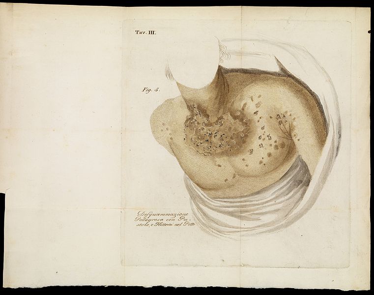 File:Illustrations of Pellagra on chest and neck Wellcome L0068056.jpg