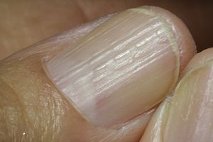 Lichen planus in finger nails.JPG