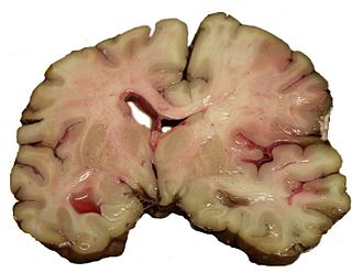 A slice of brain from the autopsy of a person who had an acute middle cerebral artery (MCA) stroke MCA-Stroke-Brain-Human-2.JPG