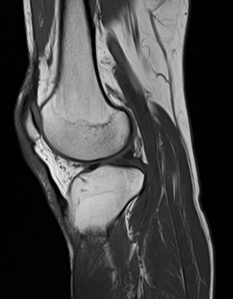 File:MRI knee abdonrmal.jpg