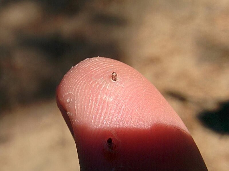 File:Mediterranean black sea urchin sting getting expelled from the body by itself after 3 weeks.jpg