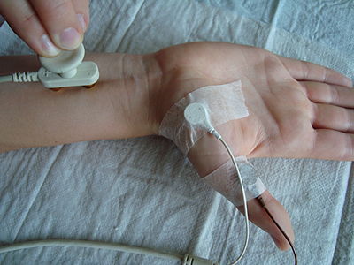 Nerve conduction study