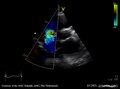 File:Severe tricuspid regurgitation E00569 (CardioNetworks ECHOpedia).webm