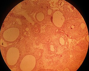 Adenomatoid odontojenik tümör.jpg