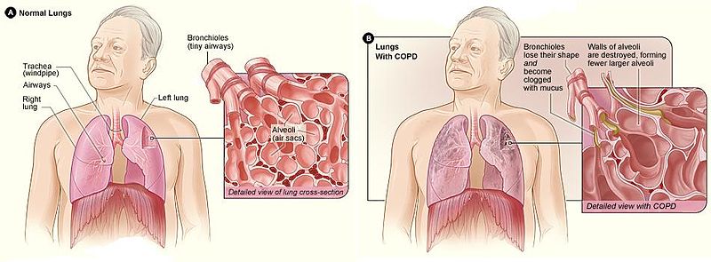 健常者の肺胞（左）とCOPD患者の肺胞（右）の比較図。肺胞壁の破壊による肺胞自体の減少などが見て取れる