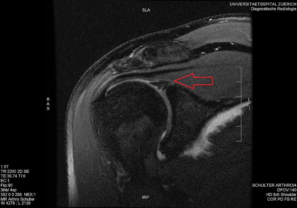 File Mri 2 Slap Ii Lesion Wikimedia Commons