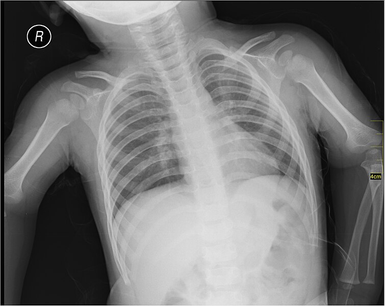 File:Medical X-Ray imaging VFB07 nevit.jpg