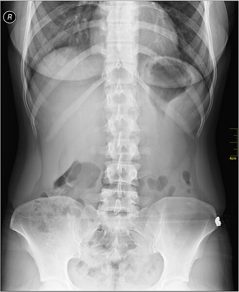 File:Medical X-Ray imaging WME07 nevit.jpg