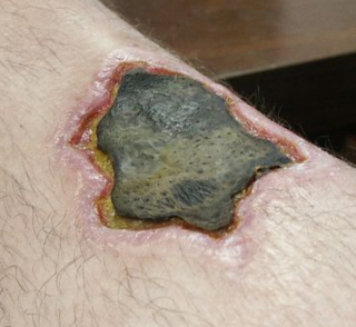 <span class="mw-page-title-main">Loxoscelism</span> Necrotising sore caused by some spider bites
