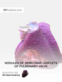 Nodules of semilunar leaflets of pulmonary valve.png