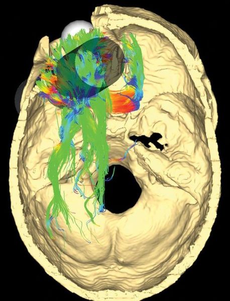 File:Simulated Connectivity Damage of Phineas Gage 4 vanHorn PathwaysDamaged right.jpg