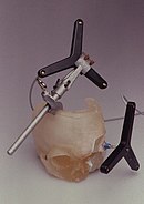 Surgical planning using bone segment navigation for the osteotomy of the left orbit, based on stereolithographic models (registration based on infrared devices) StereolithographiemodellSchaedel.jpg