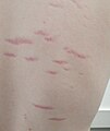 Normal stretch marks in a teenage male