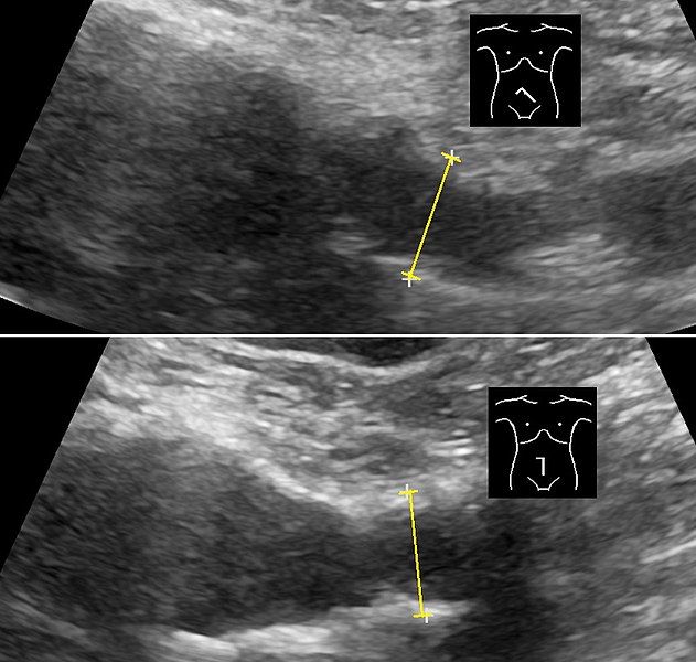 File:Ultrasonography of common iliac arteries, annotated.jpg