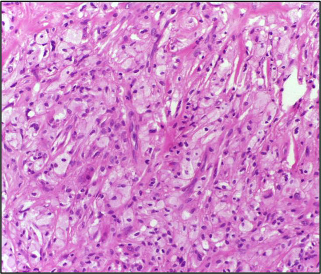 Description de l'image Xanthoma10X.jpg.