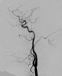 Angiogram Angiogram.jpg