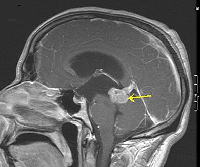 Astrocytoma