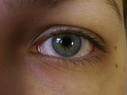 Red eyes can be treated with naphazoline.