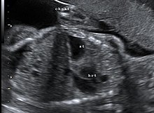 Congenital diaphragmatic hernia: coronal obstetric ultrasound (head to right of image, thorax centre, abdomen left) shows the stomach and heart both within the thorax. Cdh0002.jpg