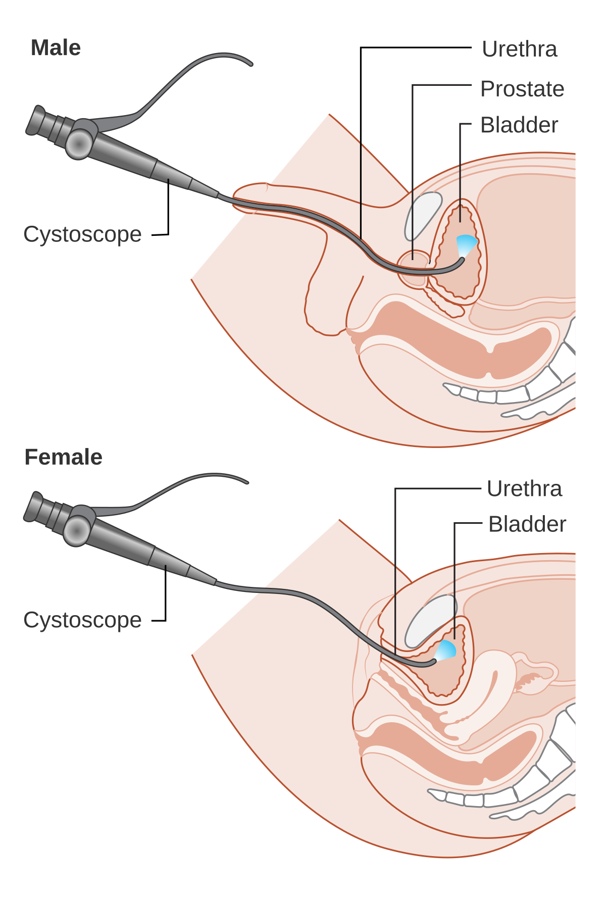 Cystoscopy Wikipedia