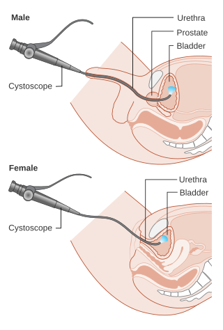 <span class="mw-page-title-main">Cystoscopy</span> Medical procedure; endoscopy of the urinary bladder via the urethra