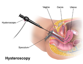 Hysteroskopie.png