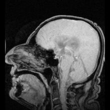 Ventricular system Wikipedia