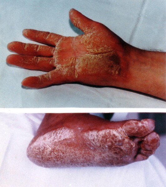 ファイル:Naxos Disease Hand Feet 01.jpg