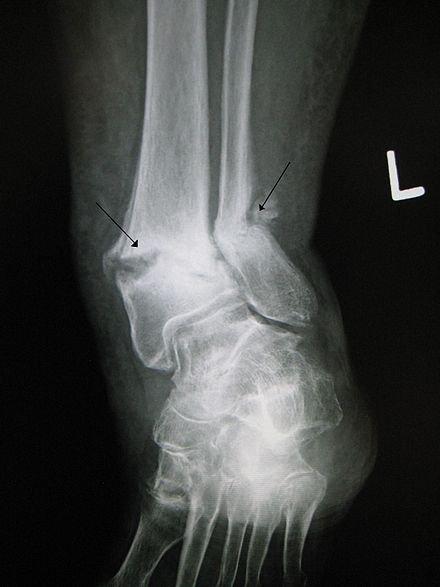 An old fracture with nonunion of the fracture fragments
