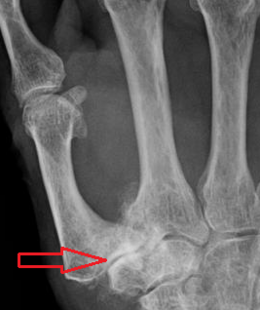 Descrizione dell'osteoartrosi dell'immagine CMC joint.png.