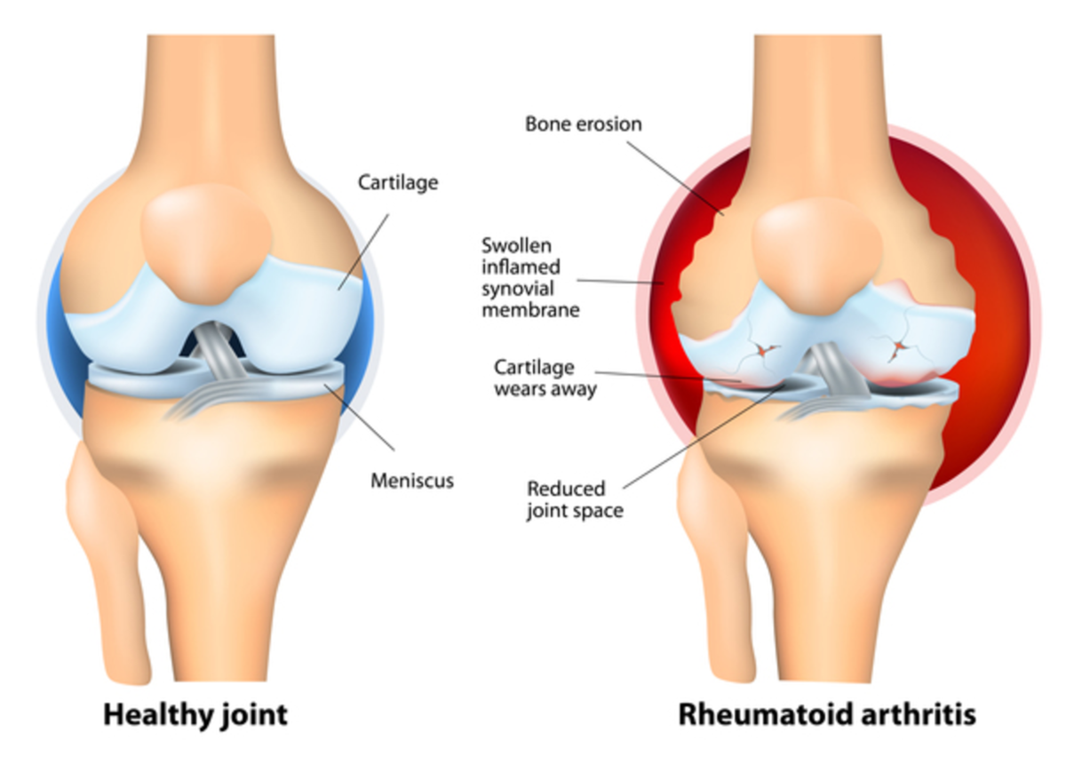 rheumatoid arthritis mely ízületek