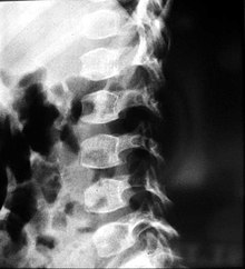 X-ray of the spine in a patient with spondyloepimetaphyseal dysplasia Spondyloepimetaphyseal-dysplasia-002.jpg