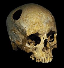 A trepanated skull, from the Neolithic. The perimeter of the hole in the skull is rounded off by ingrowth of new bony tissue, indicating that the person survived the operation. Trepanated skull of a woman-P4140363-black.jpg