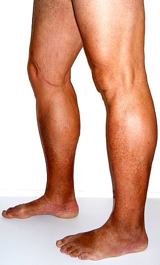 <span class="mw-page-title-main">Chronic venous insufficiency</span> Medical condition