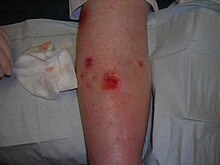 Venous ulcer dorsal leg.jpg